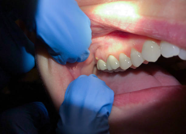 Best Knocked-Out Tooth Emergency  in Finderne, NJ